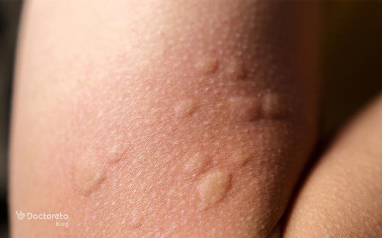 کهیر بارداری: علل، علائم و تجربیات زنان باردار از کهیر پوستی
