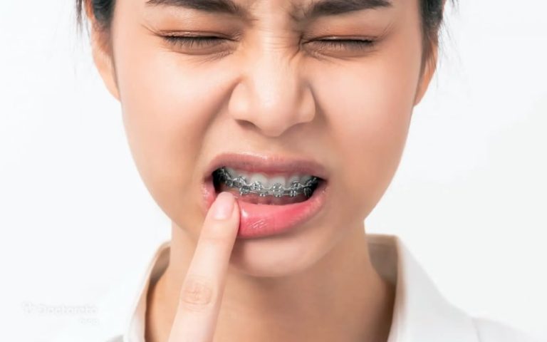 راهکارهای ساده و مؤثر برای تسکین زخم دهان بعد از ارتودنسی