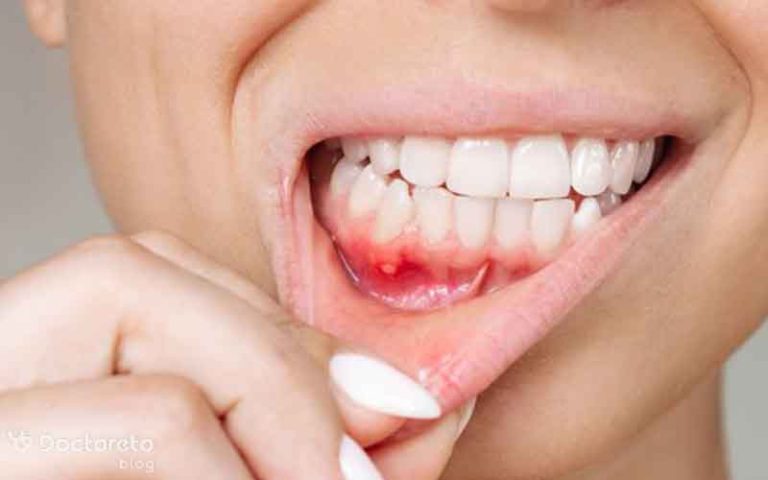 جوش دهان به چه دلیلی ایجاد می شود و چگونه آن را درمان کنیم؟