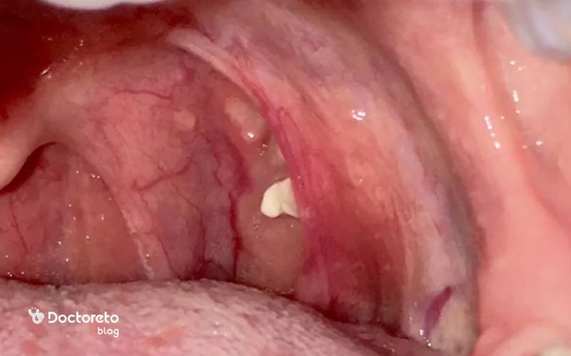 عکس سنگ لوزه در گلو