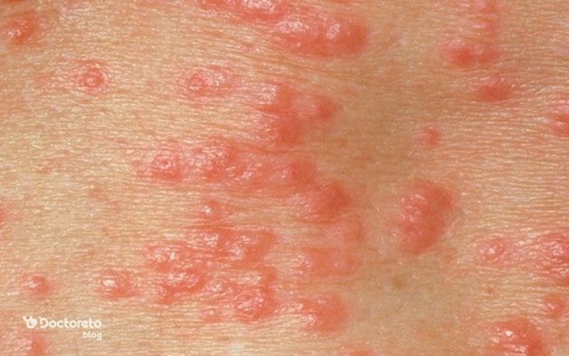 عکس تبخال تناسلی در بارداری