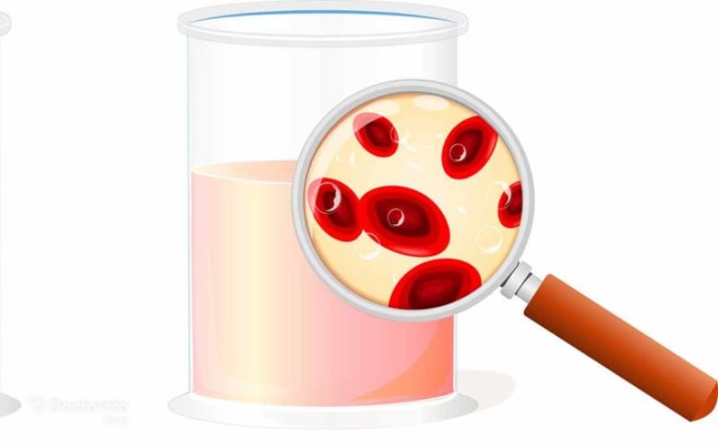 تفسیر Blood مثبت در آزمایش ادرار چیست؟