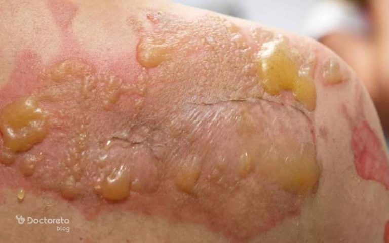 دلیل تاول زدن ناگهانی بدن چیست و کدام خطرناک است؟