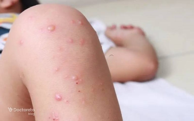 تاول پوستی در کودکان چقدر خطرناک است؟