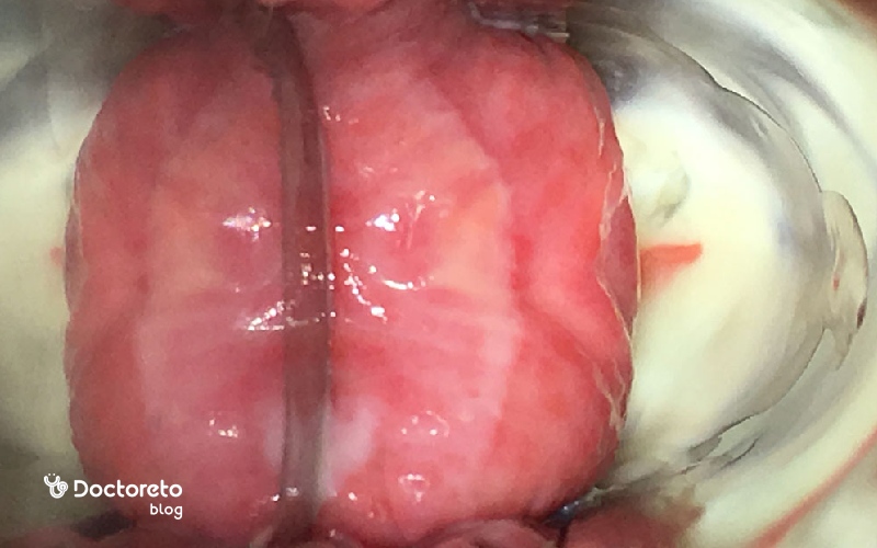 پماد برای عفونت مخمری واژن