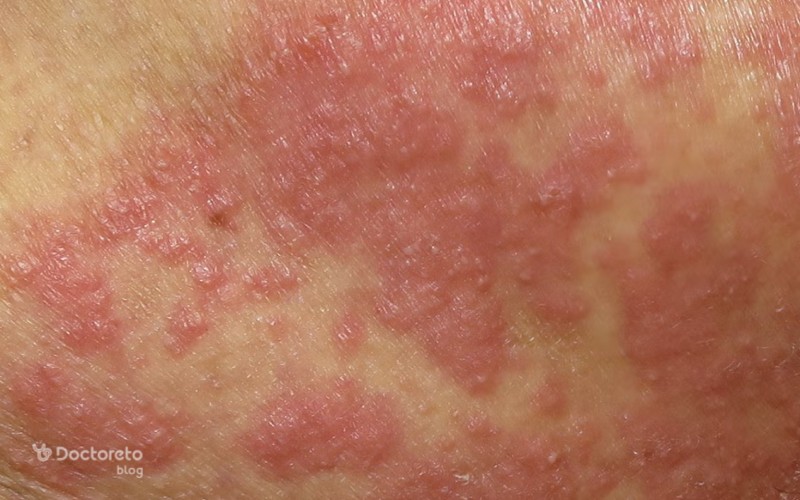 عکس قارچ پوستی کاندیدا