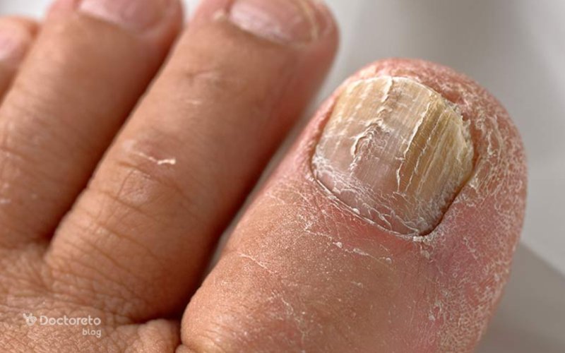 عکس انواع قارچ پوستی ناخن