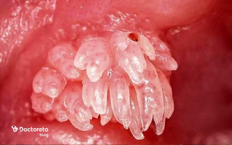 عکس واژن عفونت دار با hpv