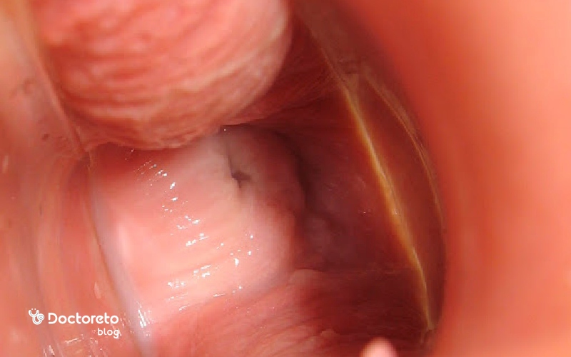 پماد برای عفونت مخمری واژن