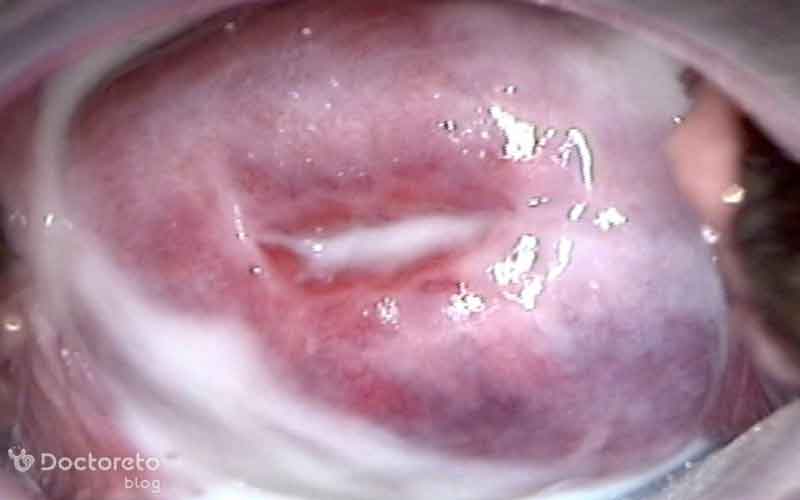 پماد برای عفونت مخمری واژن