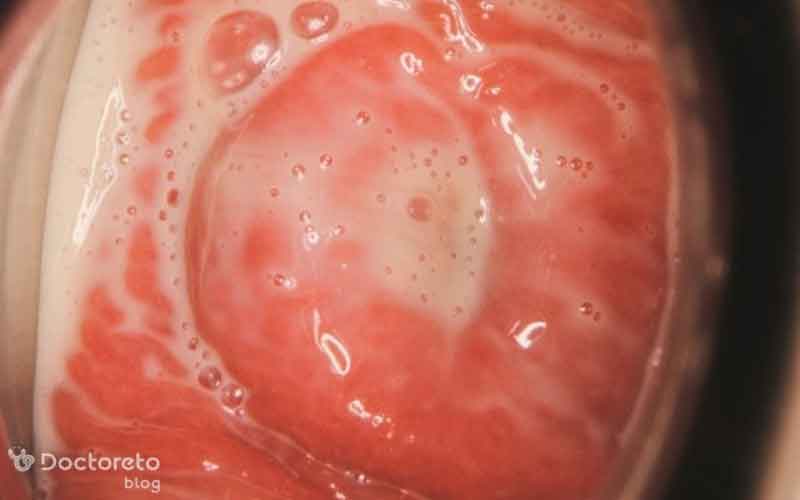 پماد برای عفونت مخمری واژن