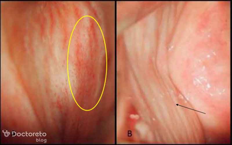 پماد برای عفونت مخمری واژن