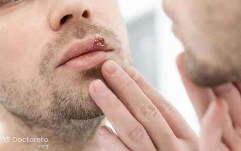 چرا تبخال لب ایجاد می شود؟