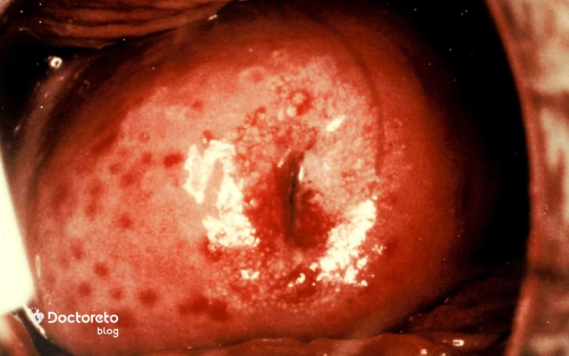 پماد برای عفونت مخمری واژن