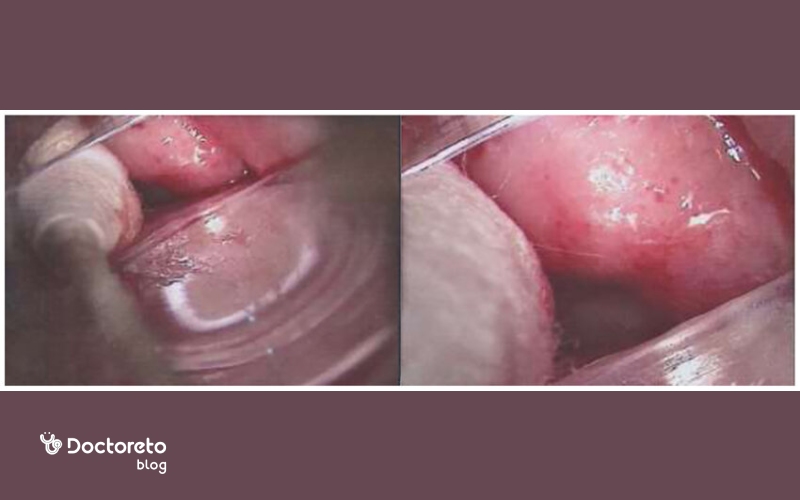 پماد برای عفونت مخمری واژن