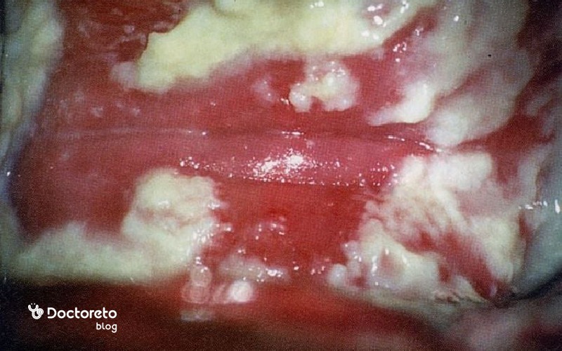 پماد برای عفونت مخمری واژن