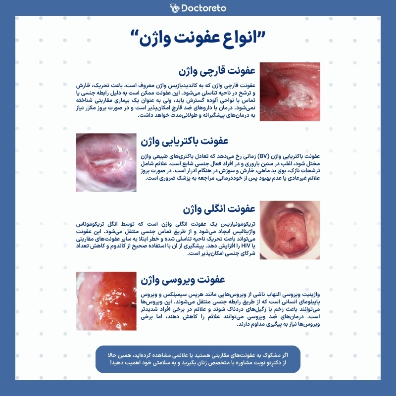 اینفوگرافی عکس انواع عفونت واژن