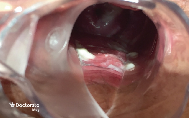 پماد برای عفونت مخمری واژن