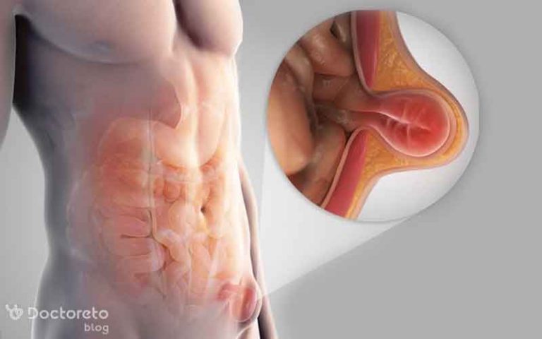 فتق بیضه چیست و چگونه می توان آن را درمان کرد؟