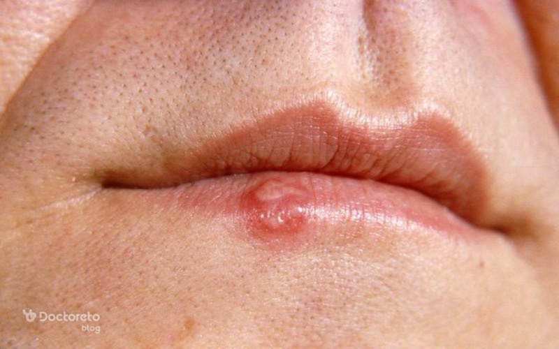 تبخال لب نشانه چیست؟