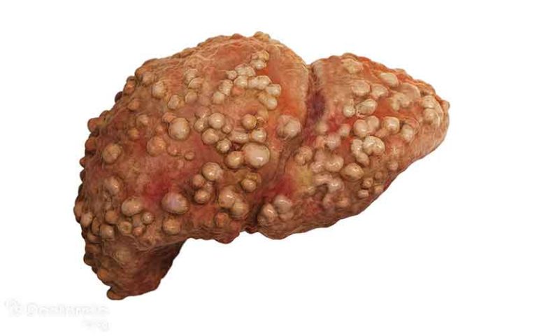 علائم سرطان کبد در افراد مختلف چیست؟