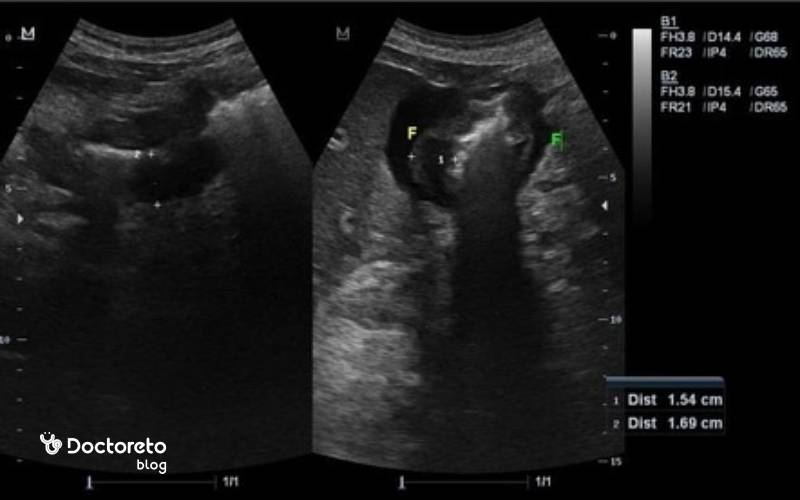 عکس سونوگرافی سرطان معده