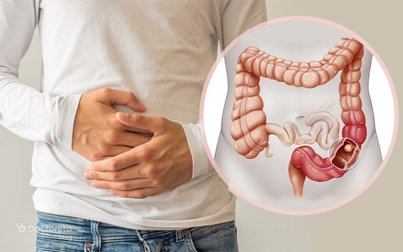 شکل مدفوع در سرطان روده چگونه است؟