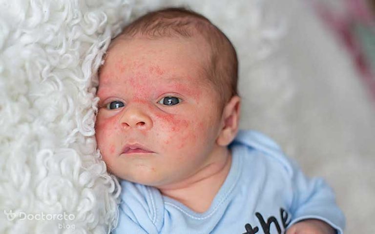 اگزما نوزاد را چگونه مهار کنیم؟