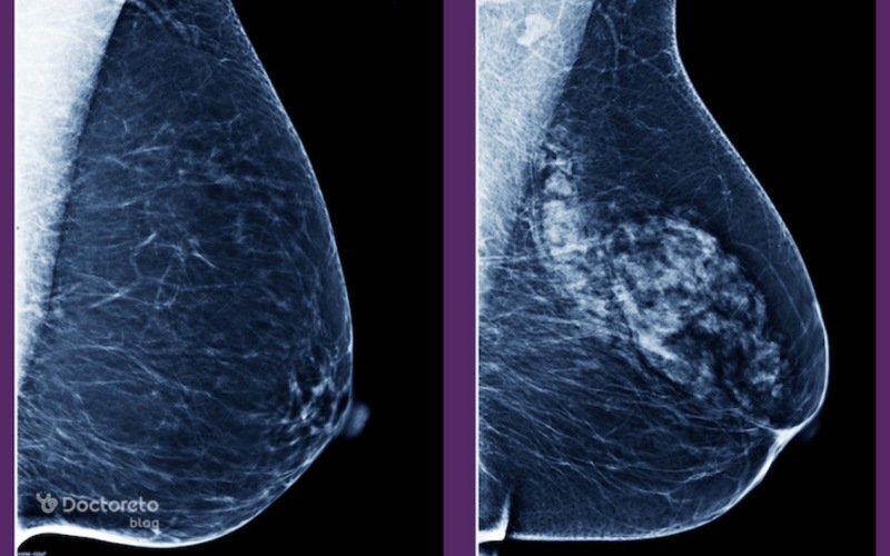 علائم اولیه سرطان پستان در زنان