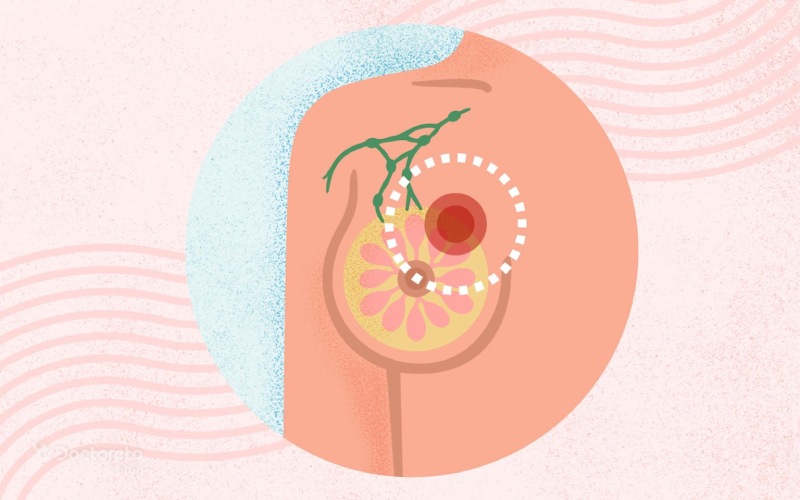 نشانه های سرطان پستان در زنان چیست؟