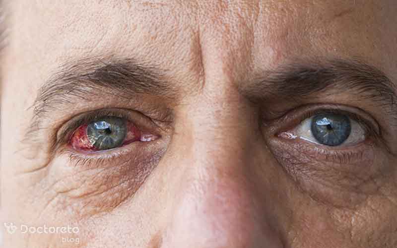 دیابت و بیماری های چشم چه ارتباطی دارند؟