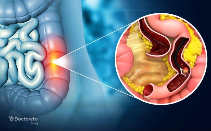 آیا پولیپ روده خطرناک است؟