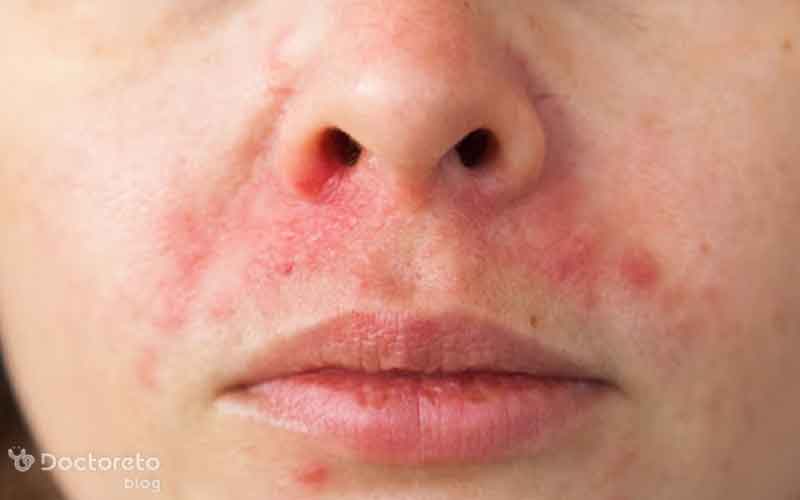 اگزما صورت چیست؟