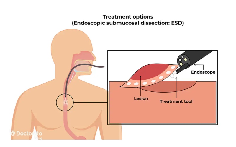 درمان سرطان مری با جراحی چیست؟