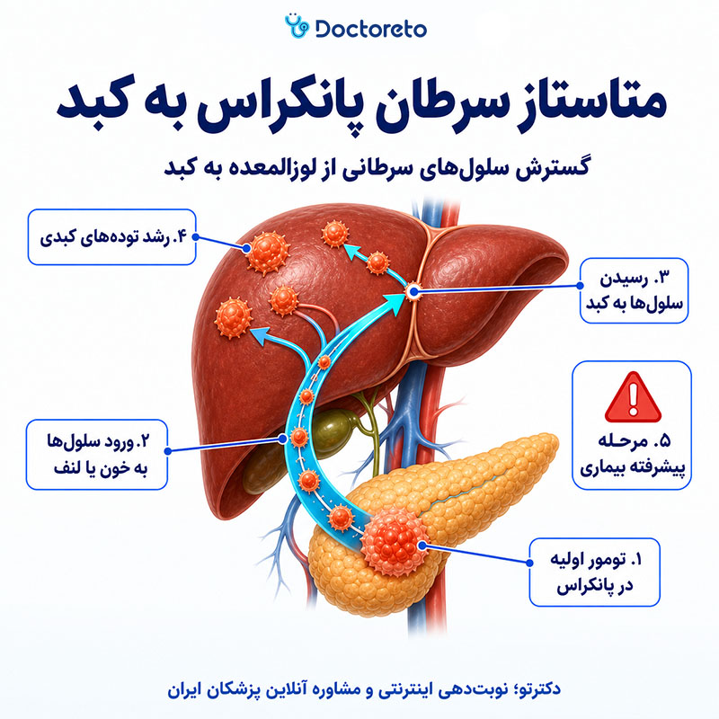 اینفوگرافی سرطان پانکراس متاستاز به کبد