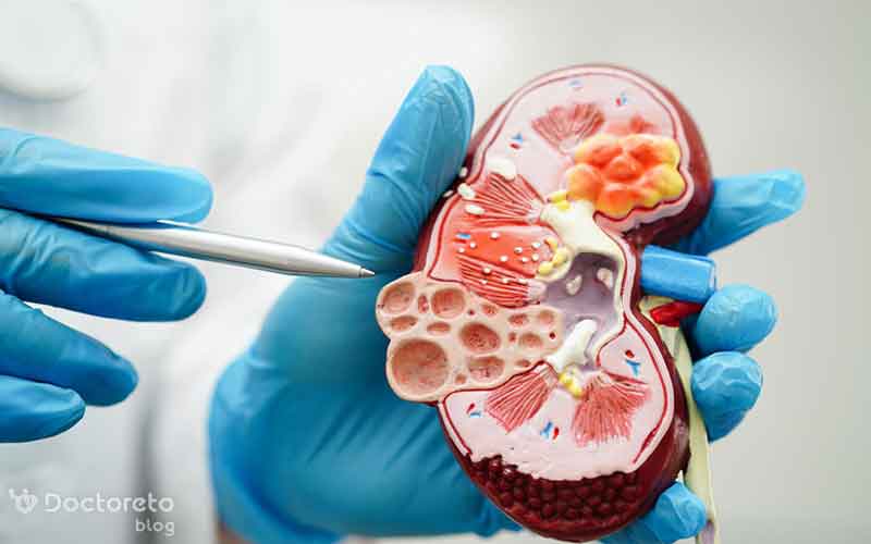 دیابت و بیماری های کلیوی چه ارتباطی با هم دارند؟