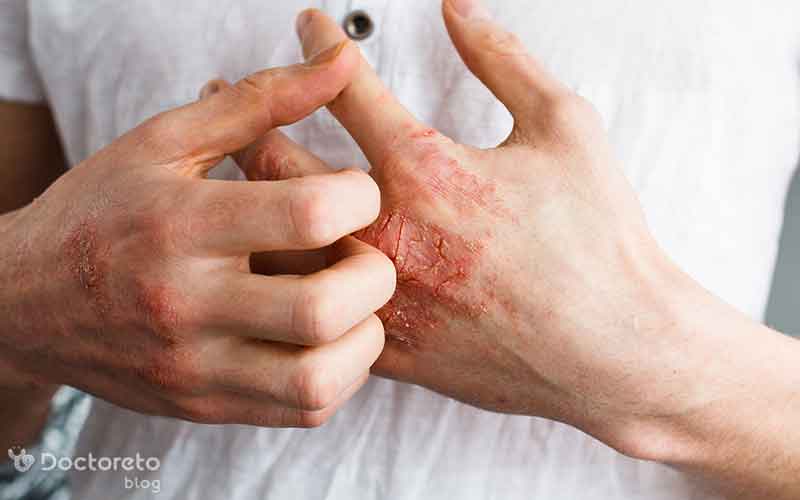 فرق اگزما و قارچ در چیست؟