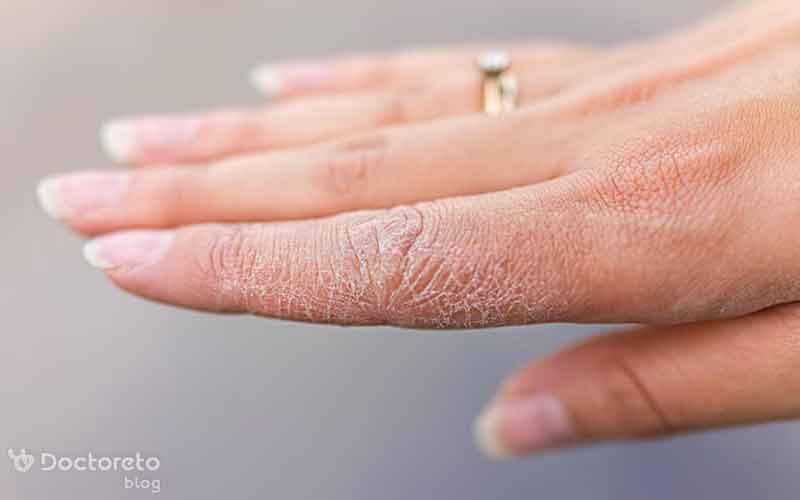 فرق اگزما و قارچ چیست؟