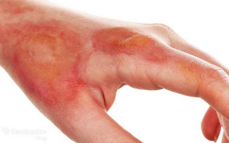 زخم دست دیابتی چه علائمی دارد؟
