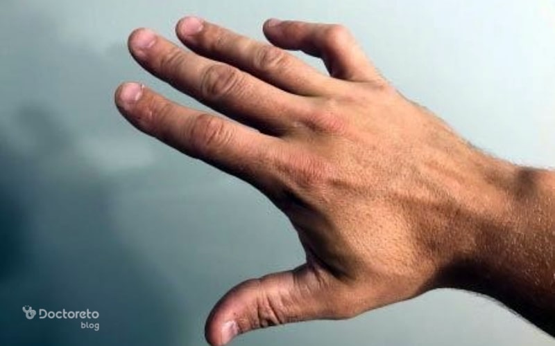 در رفتگی انگشت چه علائمی دارد؟