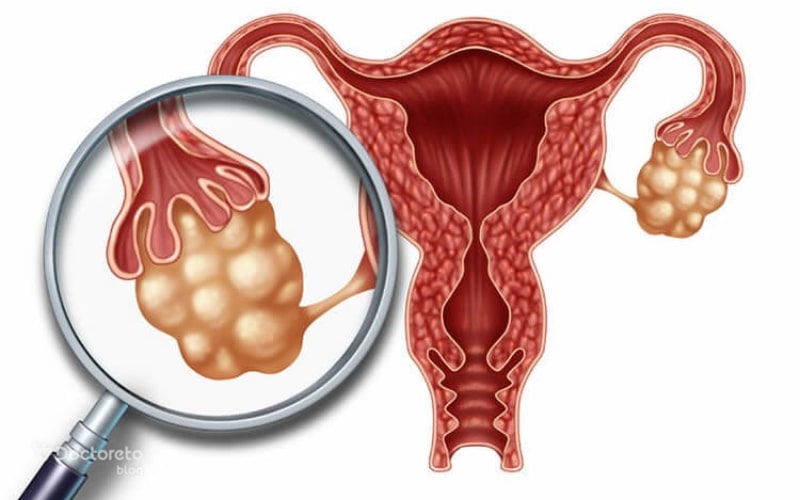 علت تخمدان پلی کیستیک در دختران جوان چیست؟