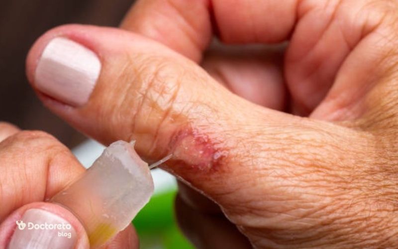 عکس زخم دست دیابتی