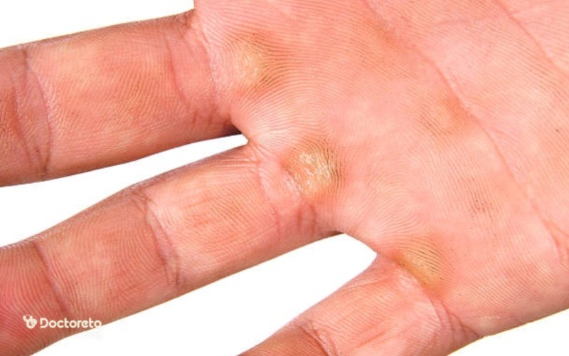 عکس پینه های دیابتی در دست