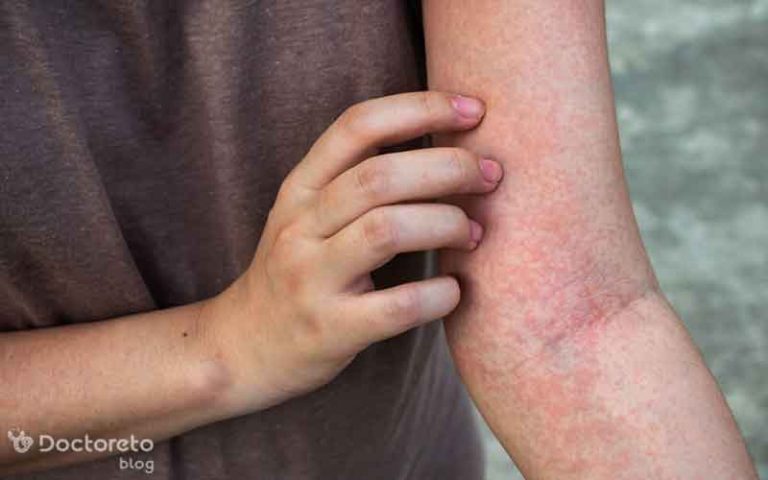 علت دانه های قرمز روی پوست همراه با خارش و روش درمان آن