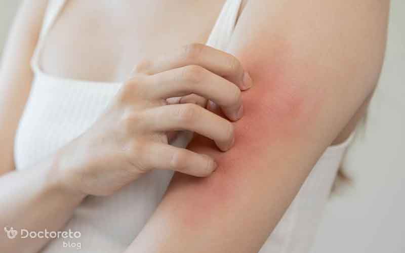 دانه های قرمز روی پوست همراه با خارش چیستند؟