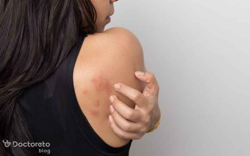 انواع دانه های قرمز روی پوست همراه با خارش نشانه چیست؟