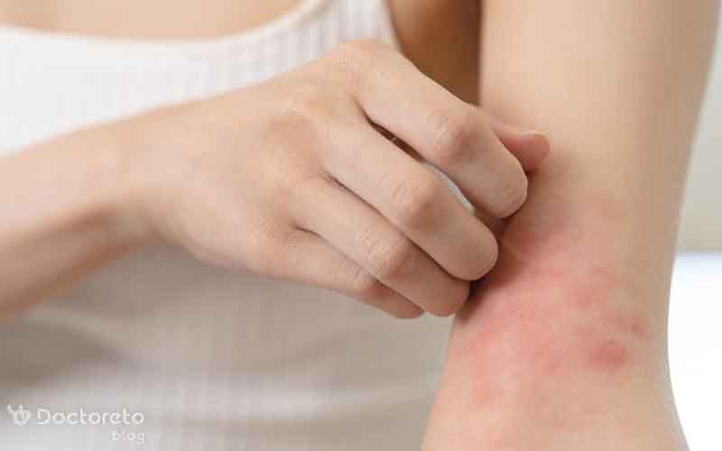 راش پوستی چیست؟