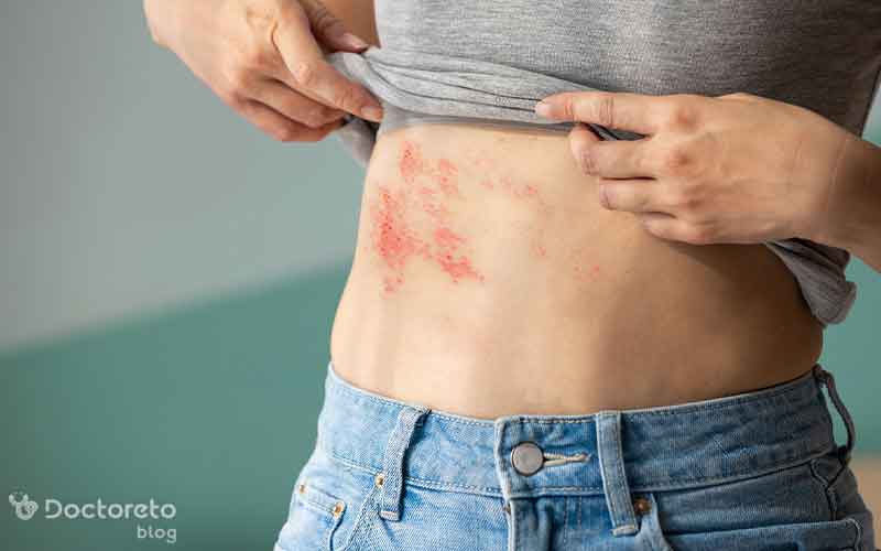راش پوستی ایدز چه علائمی دارد؟