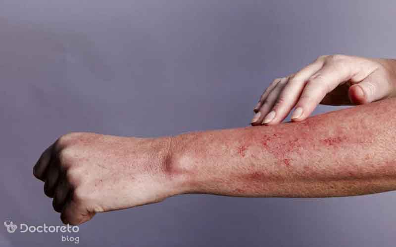 عکس راش پوستی ایدز بدین شکل است.
