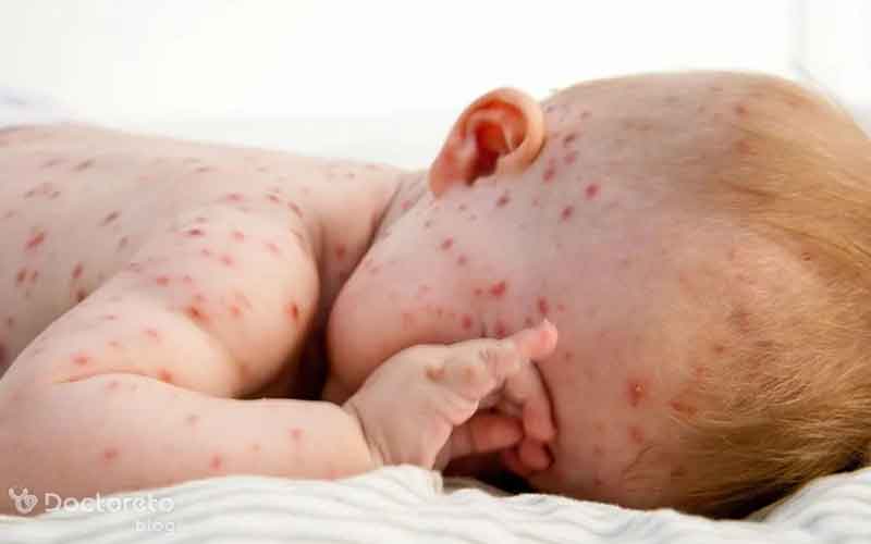 عکس دانه های قرمز روی پوست بدین شکل است. 